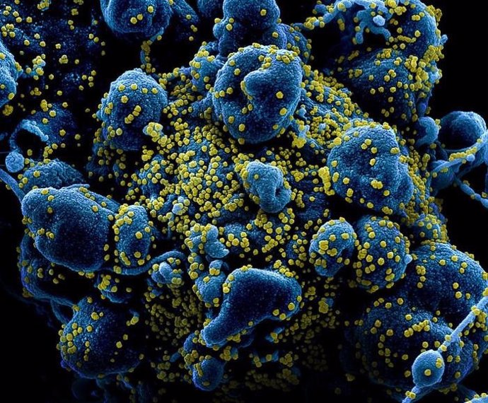 Micrografía electrónica de barrido coloreada de una célula apoptótica (azul) muy infectada con partículas del virus SARS-COV-2 (amarillo), aislada de una muestra de un paciente