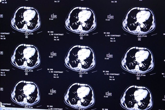 Una prueba del sueño no invasiva puede ayudar a diagnosticar y predecir la demen