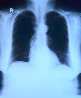 Pulmón, tórax, rayos x, radiografía