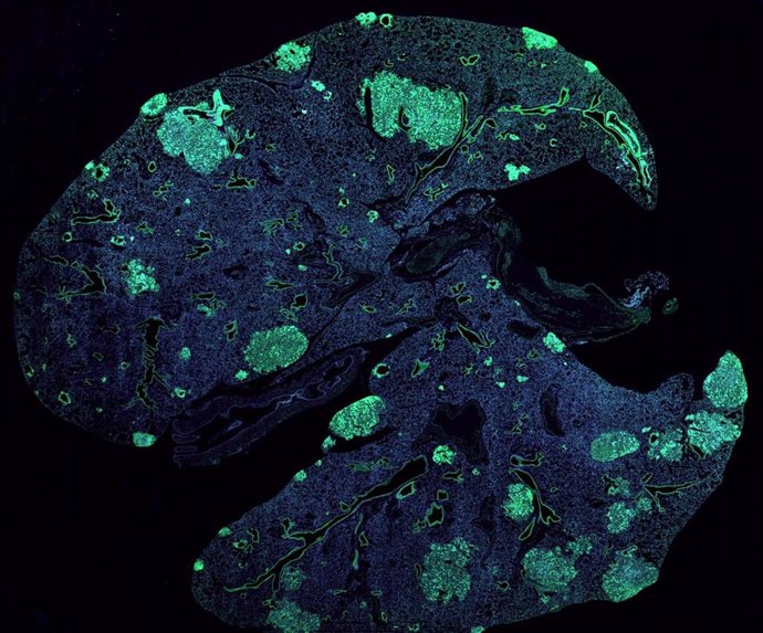 Pulmón de ratón con metástasis (verde) formado por células cancerosas que se diseminan desde un tumor de mama primario.
