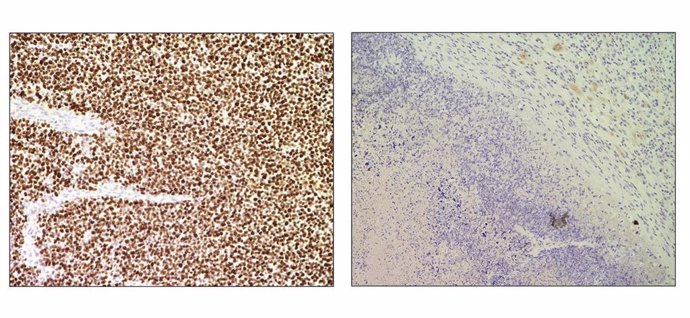 Imágenes representativas de un tumor no tratado (izquierda) comparado con otro tumor tratado (derecha) con el sistema de edición génica CRISPR para la eliminación de genes de fusión.