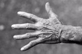 Foto: Alertan sobre el riesgo de necrosis en la mano en pacientes Covid-19, aunque admiten que es una afección rara