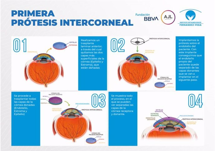 El Instituto Oftalmológico Fernández-Vega desarrolla la primera prótesis corneal que se implanta sin necesidad de realizar un trasplante penetrante
