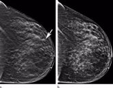 Foto: La rotura de la membrana basal, el inicio del cáncer de mama