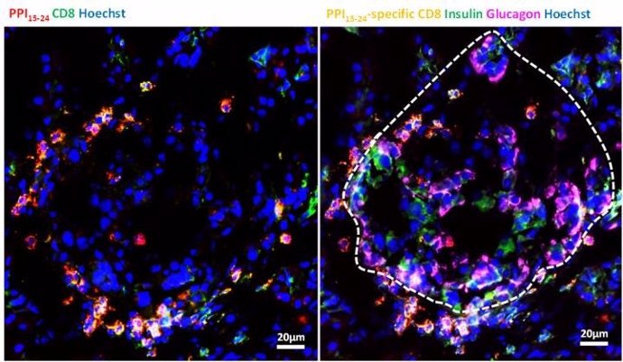 Investigadores de la diabetes detectan células T peligrosas en el páncreas, incl