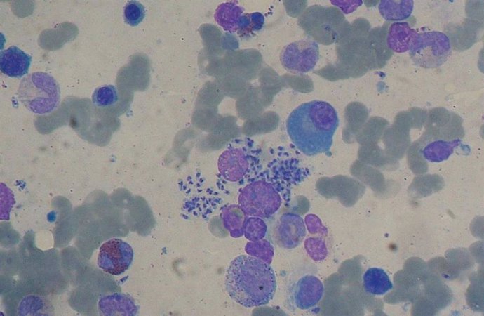 Frotis de médula ósea con leishmaniosis visceral