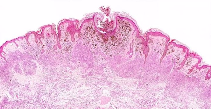 Células del melanoma (arriba) atraviesan los ganglios linfáticos y recogen una capa protectora, lo que les permite sobrevivir a altos niveles de estrés oxidativo y luego formar tumores distantes.