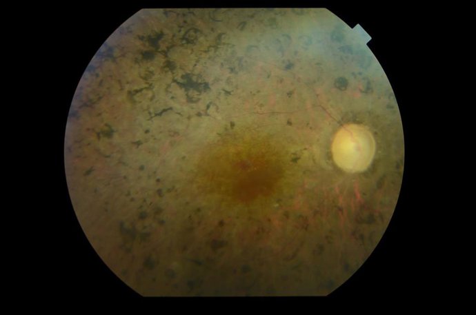 Retinosis pigmentaria
