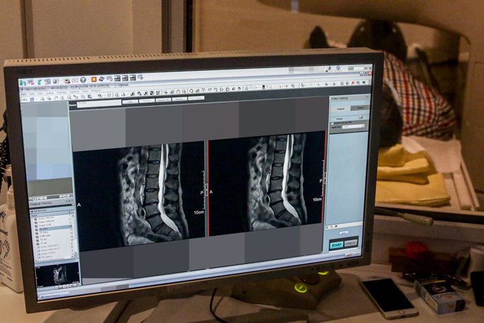 Las fracturas vertebrales son comunes en pacientes con COVID-19 y duplican el ri