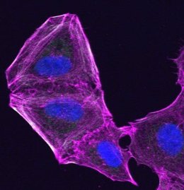 Una célula de melanoma resistente a los medicamentos que ha alterado su citoesqueleto.
