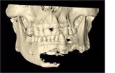 Foto: Expertos resaltan que la impresión en 3D y la cirugía virtual impulsan el futuro de la cirugía maxilofacial