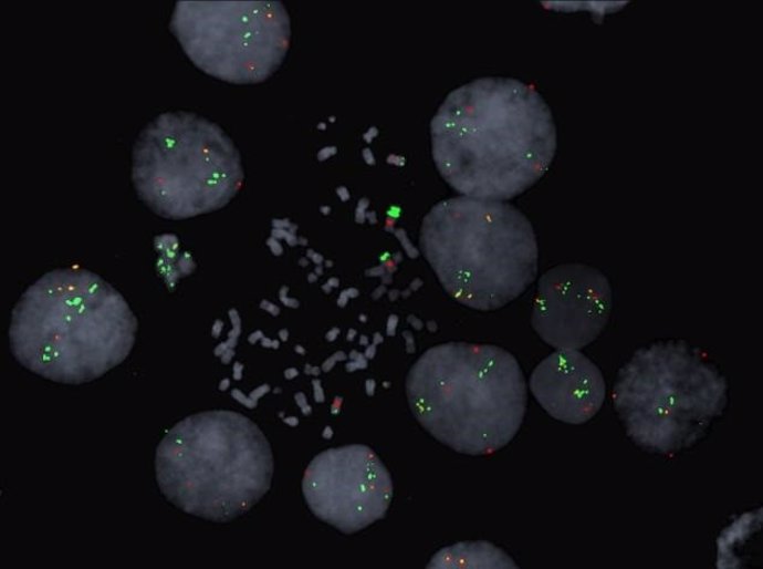 Cromosomas en células de cáncer de colon que muestran múltiples copias del gen BRAF