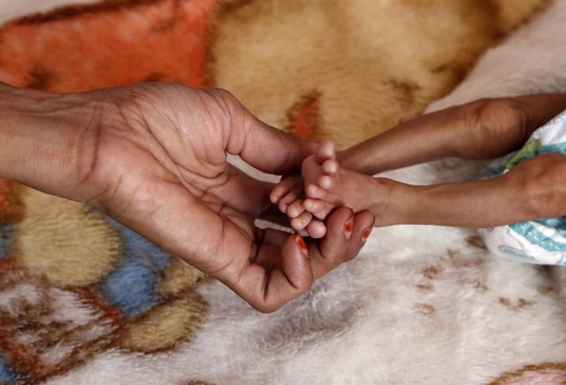 Niño con desnutricion en un hospital de Saná, Yemen