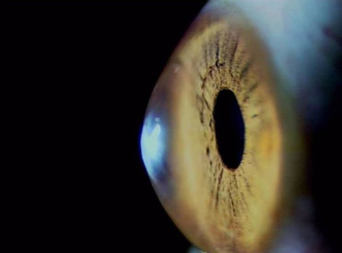 La córnea, la lente más externa del ojo, se debilita con el paso del tiempo./