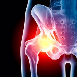 Hip in pain x-ray    Digital medical illustration: Anterior (front) x-ray view (orthogonal) of human hip. With pain zone in hip. Featuring: