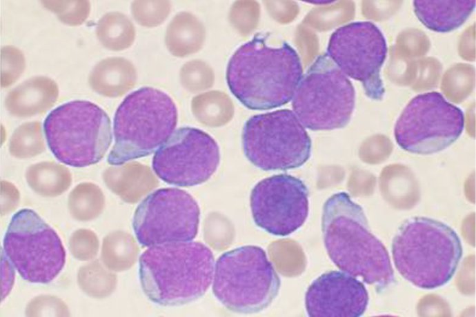 Frotis aspirado de médula ósea de una persona con leucemia linfoblástica aguda de células B