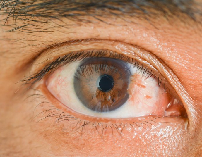 El pterigium o pterigion, conocido popularmente como o palmera, es un problema ocular bastante frecuente.