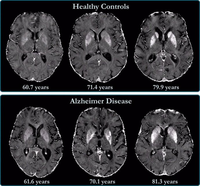 La acumulación de hierro en el cerebro está relacionada con el deterioro cognitivo en pacientes con Alzheimer.