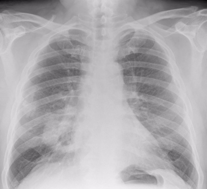 Digital chest radiograph of asbestos plaques and lung cancer