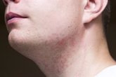 Foto: Breve guía sobre la foliculitis o cuando se nos enquistan pelos tras el afeitado o depilación