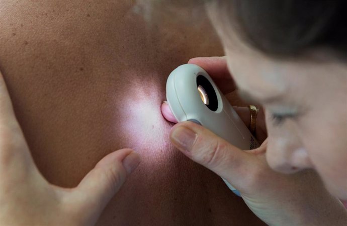 Revisión de un lunar para prevenir la aparición de melanomas