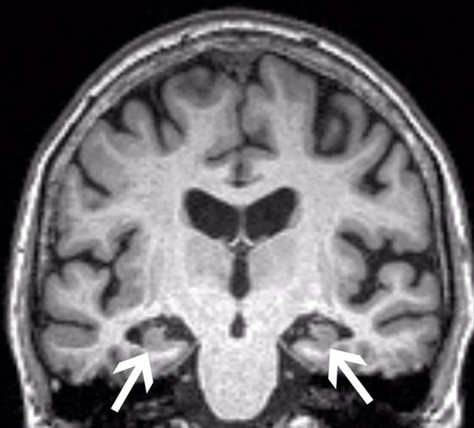 Resonancia magnética del cerebro de una mujer de 72 años muestra la pérdida de volumen del hipocampo (flechas). La paciente tenía las tres características: pérdida de volumen del hipocampo, APOE4, y ansiedad.