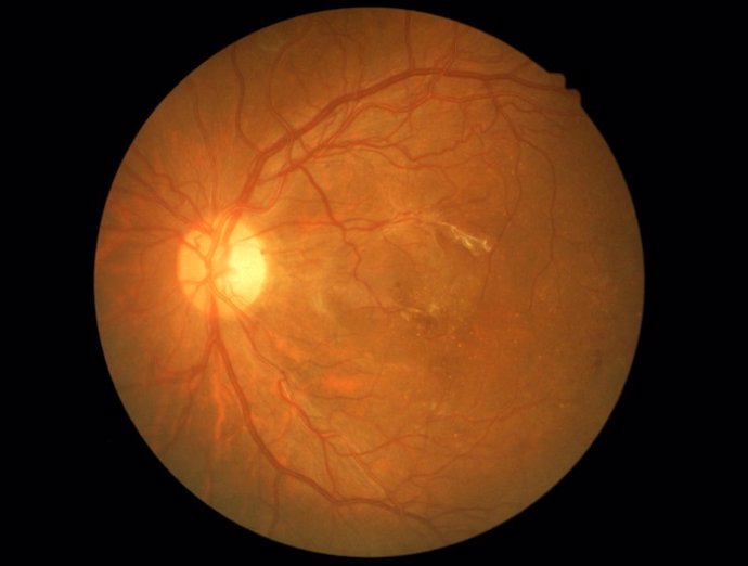 Medical photo diabetic retinopathy neovascularization