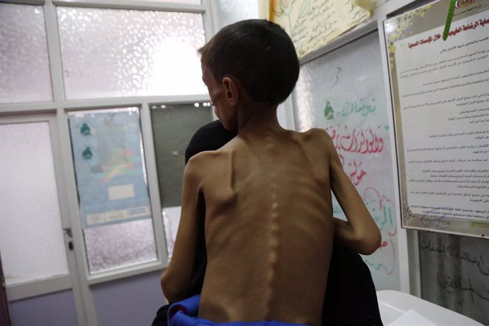 Niño desnutrido en un hospital de Saná, en Yemen