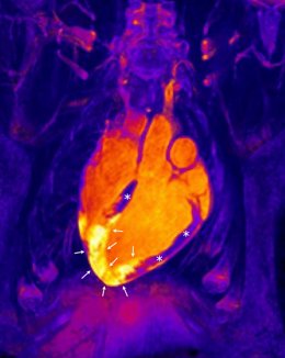 Corazón tras un infarto agudo de miocardio