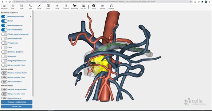 Cáncer de páncreas