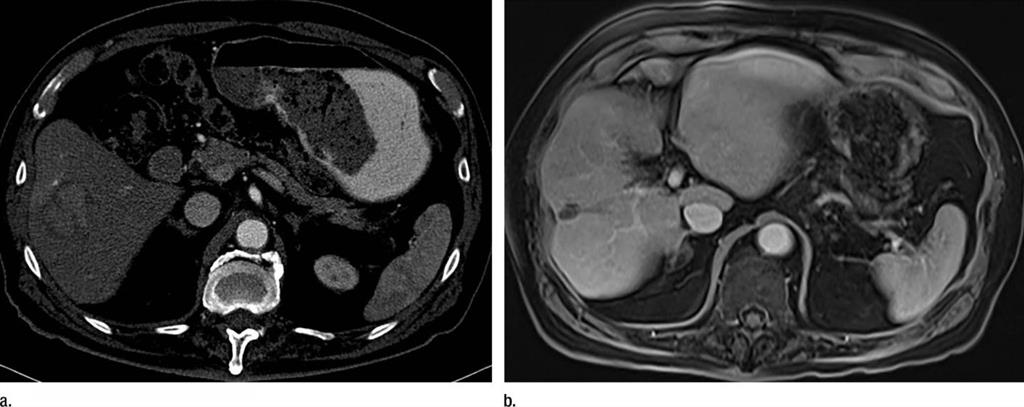 Demonstrate improvement in radiation treatment of liver cancer