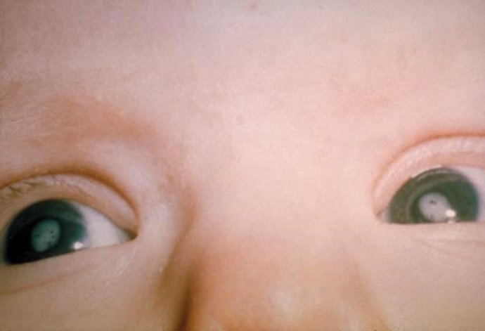 Bebé con cataratas por el síndrome de rubéola congénita