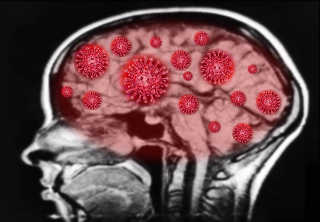 All about the neurological sequelae of Covid-19 and the possible development of Alzheimer’s