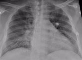 Foto: Prometedores datos clínicos sobre la capacidad del fenofibrato para prevenir el daño pulmonar en COVID-19