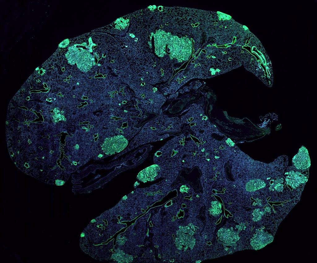 Regulatory RNAs promote breast cancer metastasis