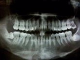 Foto: Las moléculas derivadas de Omega-3 pueden reparar el tejido dañado por la enfermedad periodontal