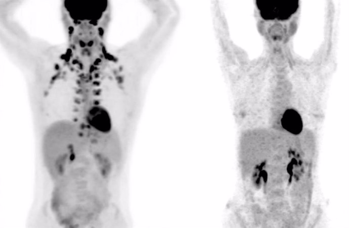 En estas tomografías, la persona de la izquierda tiene abundante grasa marrón alrededor del cuello y la columna cervical. La persona de la derecha no tiene grasa marrón detectable.