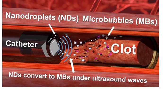 A medida que las nanogotas estallan en microburbujas, el ultrasonido hace que las microburbujas oscilen, interrumpiendo la estructura física del coágulo.