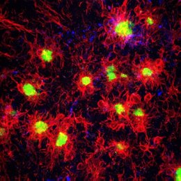 La microglia, que se muestra en rojo, rodea y reacciona a las placas beta amiloides, que se muestran en verde, en el cerebro con enfermedad de Alzheimer.