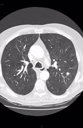 Foto: Investigadores españoles evidencian los beneficios de la 'quimioterapia metronómica' en un tipo de cáncer de pulmón