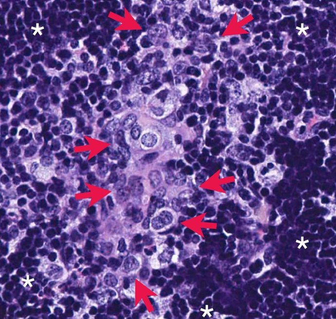 Las flechas rojas indican las células cancerosas de la próstata que han hecho metástasis en los ganglios linfáticos de un ratón genéticamente modificado. Este proceso se bloquea en ratones que carecen de la enzima PHLPP2