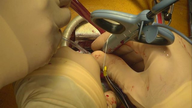    Cirujanos cardiacos del Hospital Clínico San Carlos de la Comunidad de Madrid han sido los primeros de España en reparar la insuficiencia mitral mediante la implantación de cuerdas tendinosas artificiales, con cirugía mínimamente invasiva y sin parar e