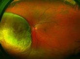 Foto: La pérdida visual puede ser una señal de alarma de diversos tumores, no solo de los que afectan a la estructura ocular
