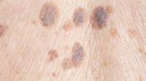 Foto: Identifican un agente terapéutico prometedor contra el melanoma
