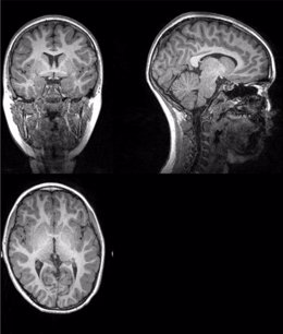 Ejemplo de imagen original de la resonancia magnética a partir de la cual investigadores de la UGR han extraído la cantidad total de materia gris, materia blanca, y cantidad total cerebral