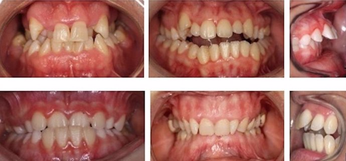 La corrección de maloclusiones y malposiciones dentarias recupera la funcionalidad de la boca
