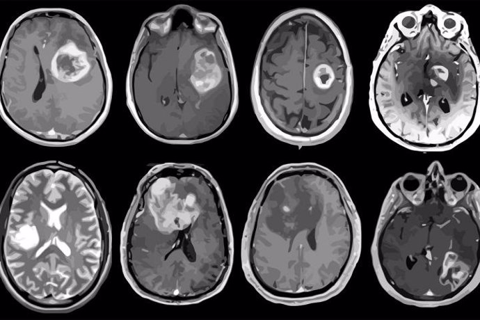 Glioblastoma, tumor cerebral agresivo mapeado en detalle genético y molecular.