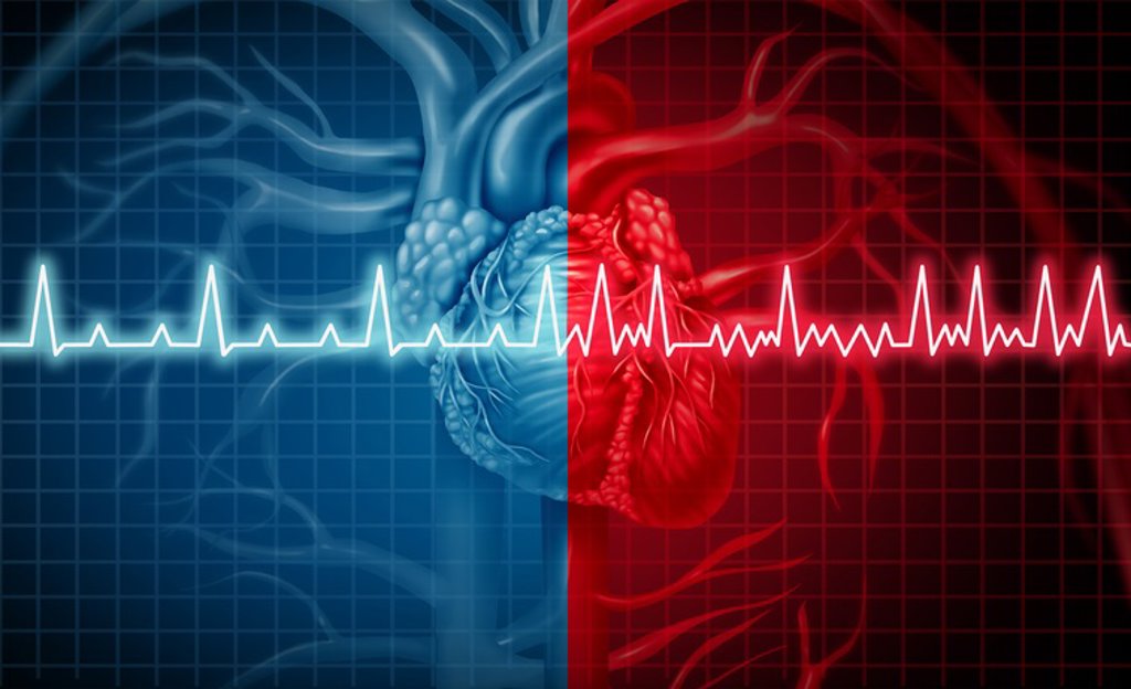 10 cosas sobre hipertensión pulmonar precapilar