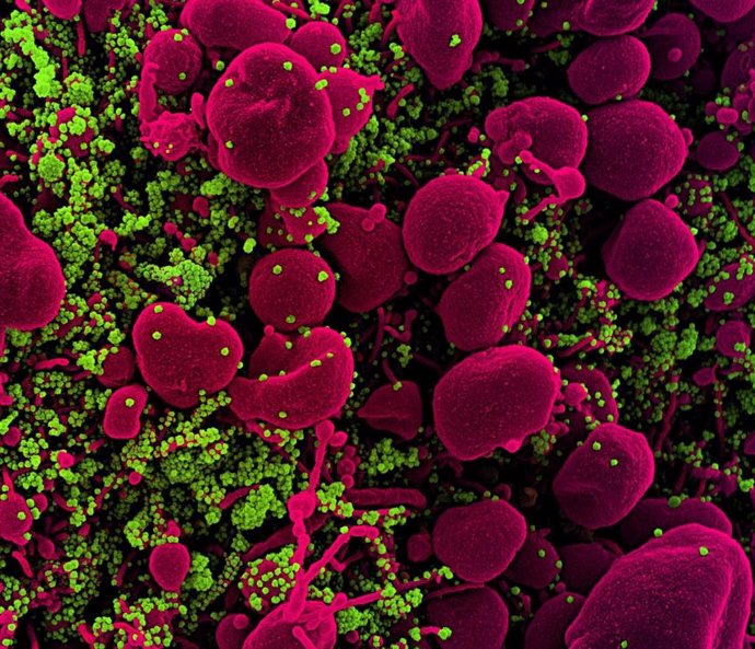 Micrografía electrónica de barrido coloreada de una célula apoptótica (rosa) muy infectada con partículas del virus SARS-COV-2 (verde), aislada de una muestra de un paciente.