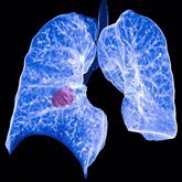 Foto: GECP asegura que puede ser posible doblar la supervivencia del cáncer de pulmón a los 5 años